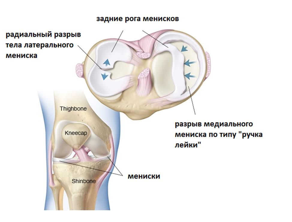 Повреждение мениска коленного сустава – симптомы и лечение без операции